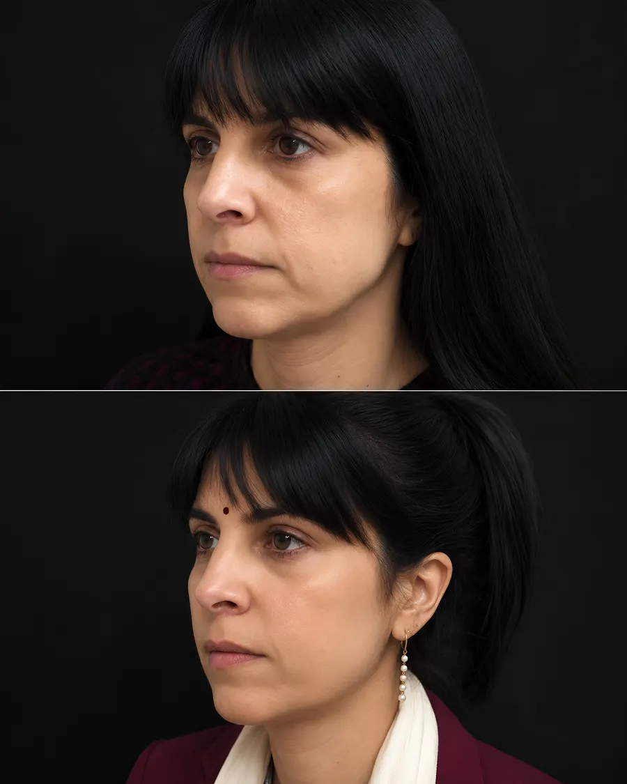 Advanced Skin Rejuvenation with Skin Tightening Laser at Cinch Clinics